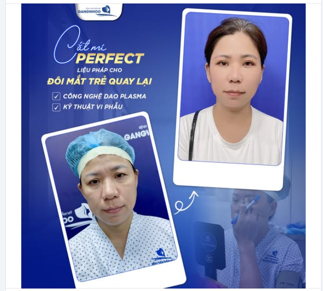 CẮT MÍ PERFECT - LIỆU PHÁP CHO ĐÔI MẮT TRẺ QUAY LẠI