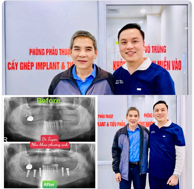 Cấy ghép Implant toàn hàm – Giải pháp phục hồi nụ cười: