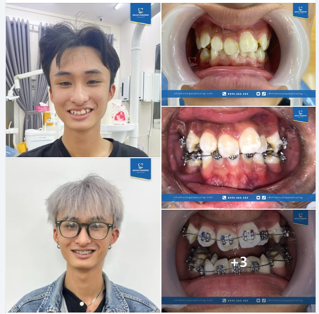 Niềng răng 2 năm răng sẽ chạy như thế nào?