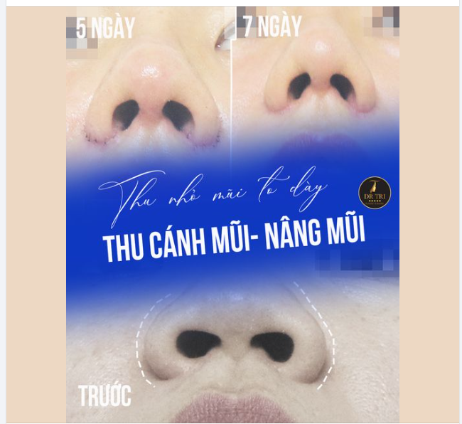 MŨI CAO – THON GỌN SAU 7 NGÀY? CÓ THẬT!
