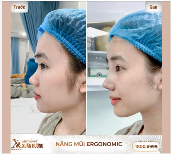 MŨI SAU KHI NÂNG CHĂM SÓC NHƯ THẾ NÀO ĐỂ NHANH HỒI PHỤC?