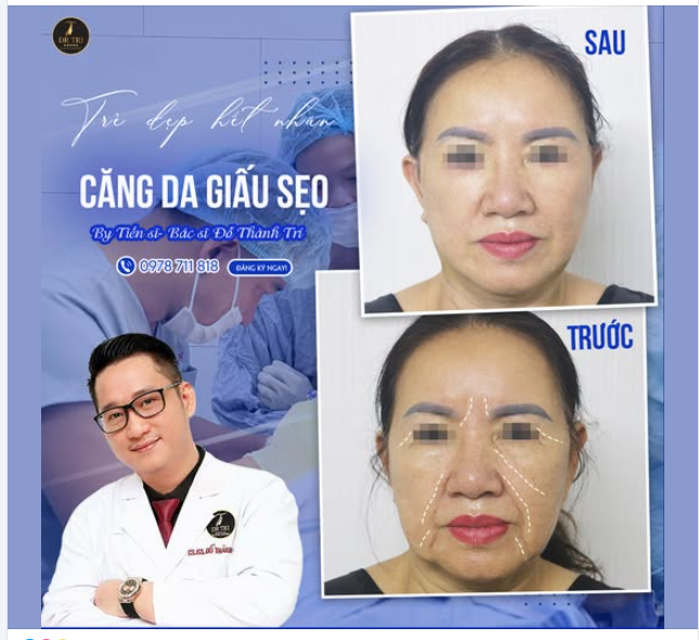 CĂNG DA V-LINE GIẤU SẸO SAU 6 NGÀY