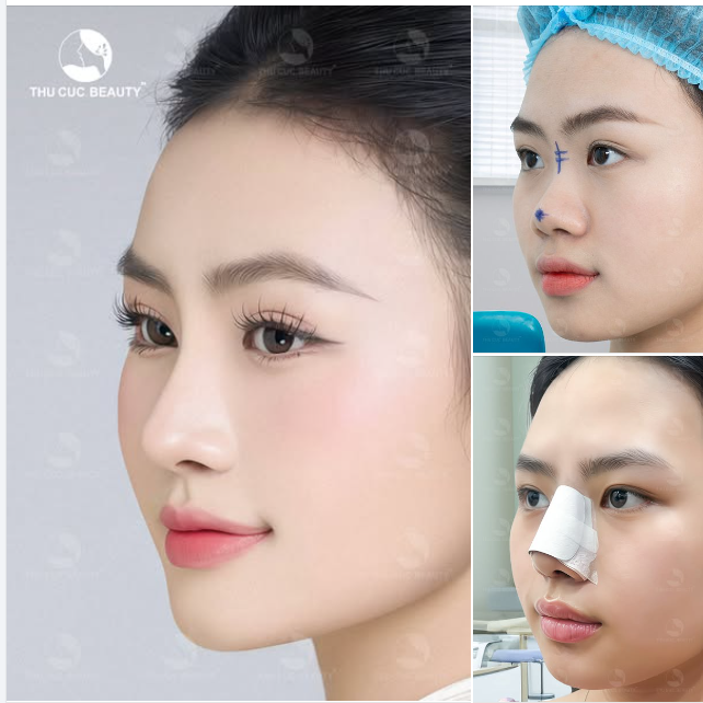 Định hình dáng mũi tự nhiên chuẩn tỷ lệ vàng  Độ cao vừa phải. Không lộ sụn