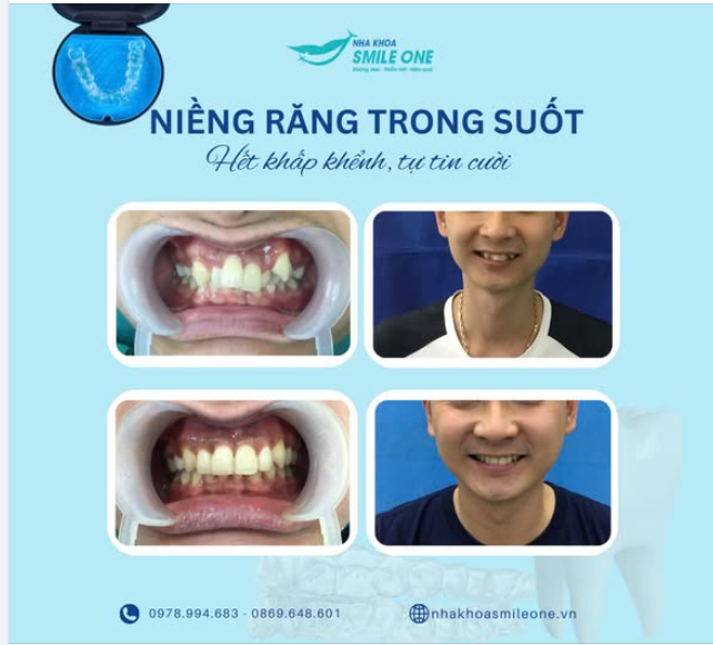 Lột xác nụ cười với công nghệ Niềng Răng Trong Suốt tại nha khoa Smile One