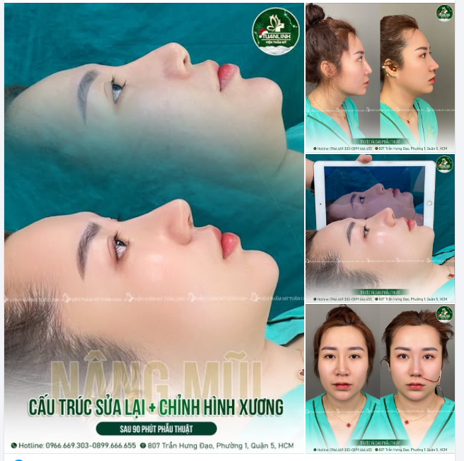 Nâng mũi cấu trúc + Chỉnh hình xương Tái tạo dáng mũi đẹp hoàn hảo!!