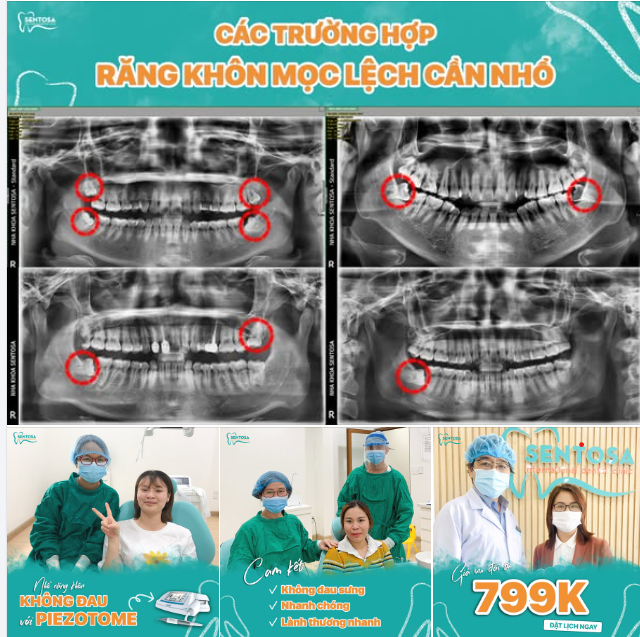 NHỔ RĂNG KHÔN MỌC LỆCH TỪ 799.000 VND/RĂNG
