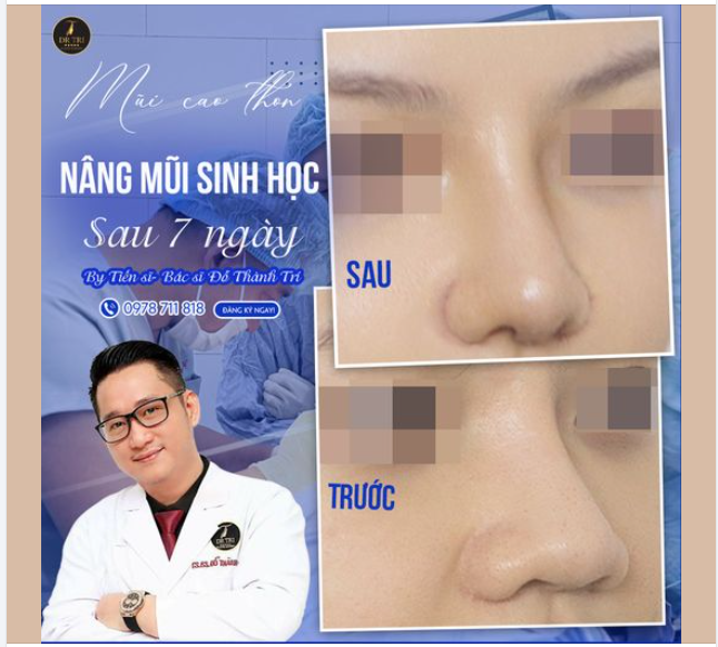 Dáng mũi cao thon, nổi bật trong mọi khoảnh khắc chỉ sau 7 ngày!