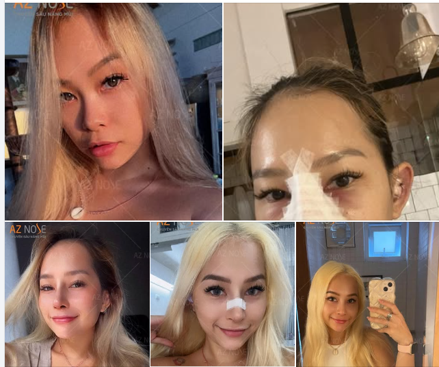 "Mình chia sẻ sơ về quá trình nâng mũi tại AZ NOSE nha. Mình làm hồi cuối tháng 23/11.