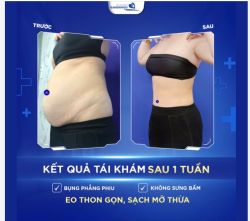 BỤNG PHẲNG PHIU, KHÔNG SƯNG BẦM SAU 1 TUẦN GIẢM MỠ LIPO ULTRASOUND