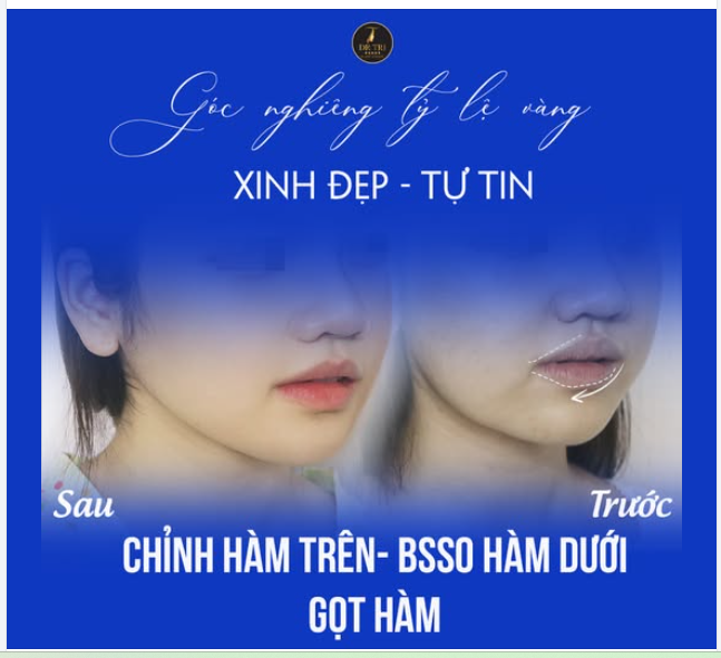 CHỈNH LỆCH MẶT THÀNH CÔNG MỸ MÃN với Combo:  Chỉnh Hàm Trên  BSSO Hàm Dưới  Gọt Hàm