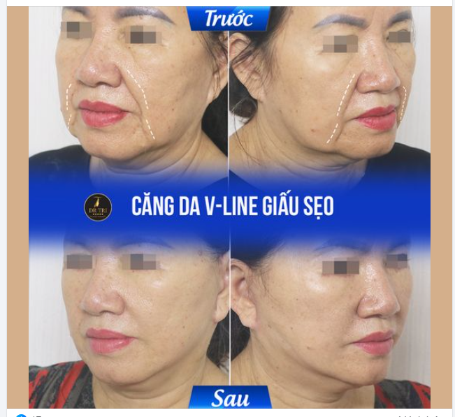 NHĂN MẤY CŨNG PHẲNG  Hình mộc Cô khách trẻ đẹp với Căng da Vline giấu sẹo