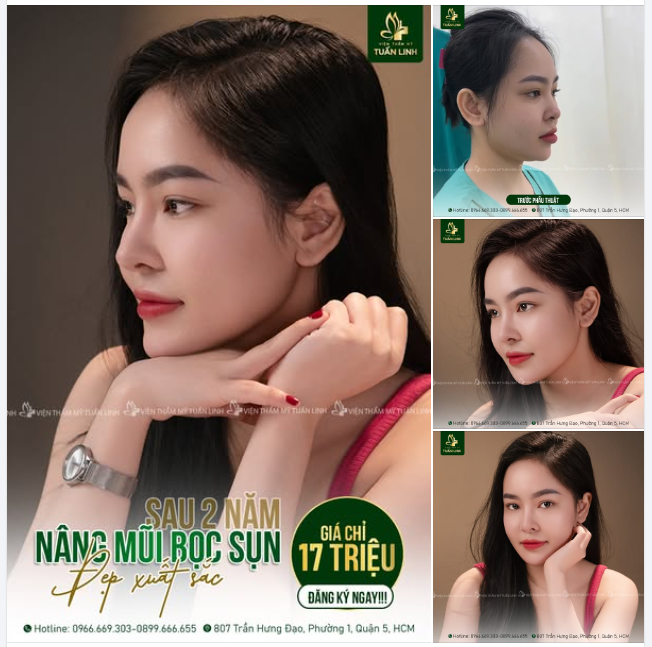 Mũi Sline bọc sụn giá chỉ 17Triệu trọn gói - Đẹp tự nhiên, bền chắc dài lâu!!