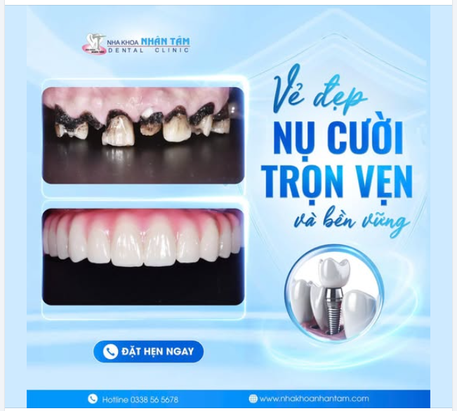 Ở tuổi 62, chú N.H.N, Việt kiều Mỹ, đã từng rất tự ti vì hàm răng bị viêm nha chu nặng, lung lay và ê buốt. Sau khi điều trị tại Nha khoa Nhân Tâm, chú đã hoàn toàn “lột xác”.