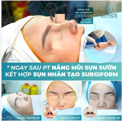 SỰ KẾT HỢP “ĐỈNH CỦA ĐỈNH” trong nâng mũi