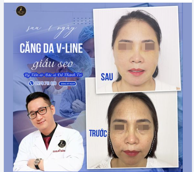 Khác biệt sõ rệt sau 1 ngày Căng da V-Line giấu sẹo tại Dr Trí