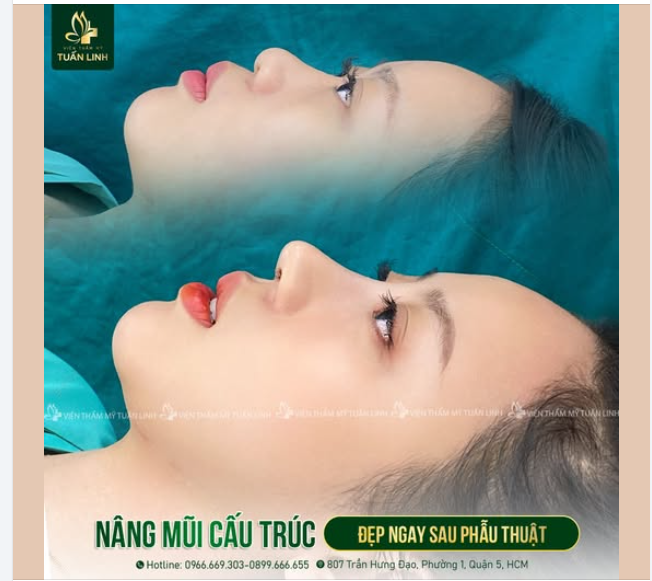 Nâng mũi cấu trúc - Dáng tự nhiên Đẹp ngay sau phẫu thuật!!