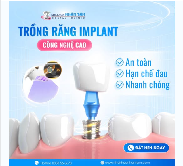 Trồng răng Implant công nghệ cao Sau 1h Có răng thẩm mỹ