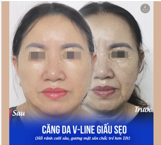 Tỷ lệ 10/10 khách feedback về phẫu thuật căng da V-Line ở Dr Trí là hồi phục nhanh mà không có dấu hiệu sưng bầm nhiều