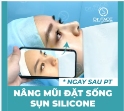 CHỈ ĐẶT SỐNG không nâng đầu mũi SAO MÀ ĐẸP ĐƯỢC?