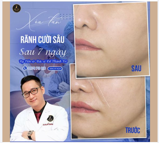 Hình ảnh Chị khách quen quay lại DrTrí thực hiện Implant rãnh cười, làm đầy nếp nhăn sâu vùng rãnh mũi má, sau 7 ngày thấy rõ hiệu quả.