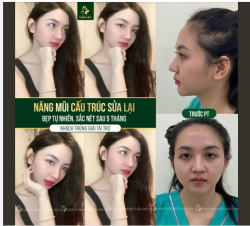 Mũi cấu trúc sửa lại cho khách hàng được tài trợ chương trình " Nâng mũi 0 Đồng'' - Dáng mũi sau 5 tháng của bạn đẹp xuất sắc chưa ạ?