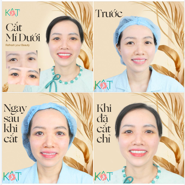 CHO ĐÔI MẮT THÊM PHẦN TRẺ TRUNG