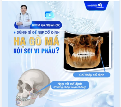 HẠ GÒ MÁ NỘI SOI VI PHẪU BVTM GANGWHOO DÙNG GÌ ĐỂ NẸP CỐ ĐỊNH SAU HẠ GÒ MÁ?