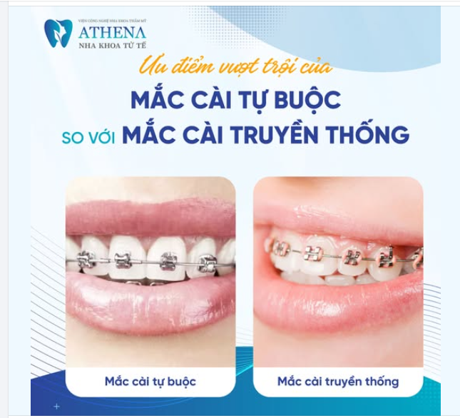 Ưu điểm vượt trội của mắc cài tự buộc và mắc cài truyền thống