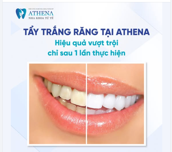 Bạn muốn có nụ cười trắng sáng để tự tin trong những bữa tiệc hay những dịp quan trọng?