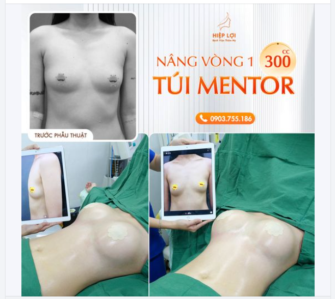 TẠM BIỆT NHỎ, LÉP - UPSIZE NGỰC với túi Mentor 300CC