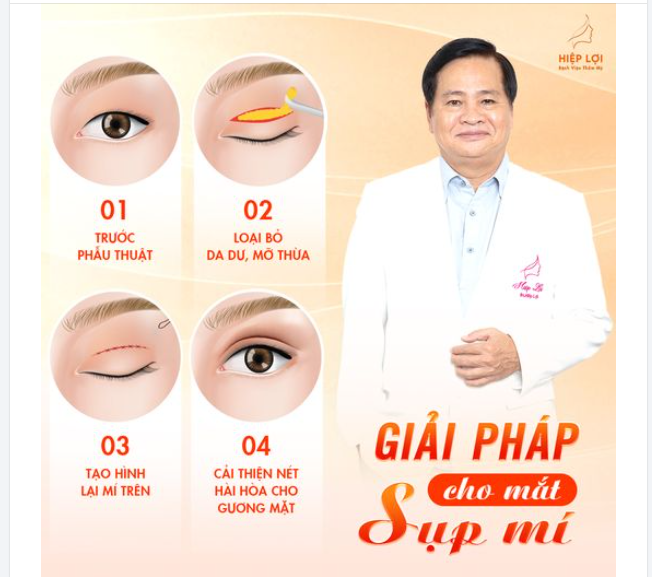 Sụp mí mắt là gì?