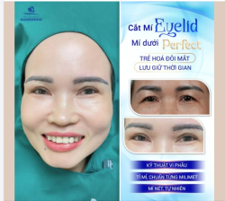 CẮT MÍ EYELID + MÍ DƯỚI PERFECT - TRẺ HOÁ ĐÔI MẮT, LƯU GIỮ THỜI GIAN