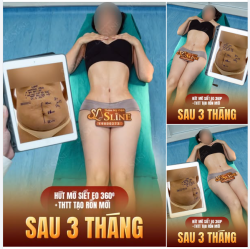 MỠTHỪA, DA CHÙNG, RỐN BIẾN DẠNG SAU SINH