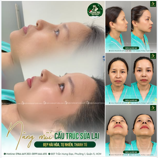 Nâng mũi cấu trúc sửa lại - Đẹp tự nhiên, thanh tú, sắc nét!!
