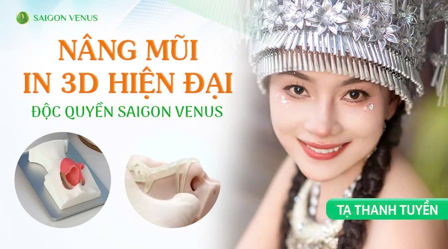 THANH TUYỀN - NÂNG MŨI SỤN SƯỜN KẾT HỢP SÓNG IN 3D