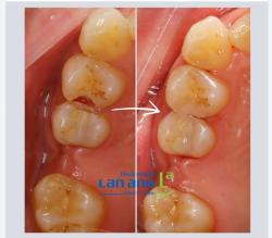 Sâu răng ở kẽ răng thường rất khó trám, vì 2 răng nối liền nhau, và thường là sâu ở cả 2 răng luôn ạ.