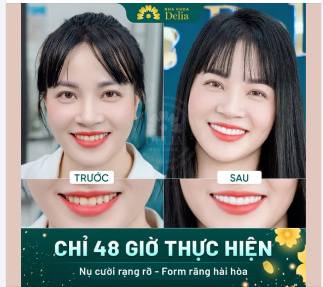 CHỈ 48 GIỜ THỰC HIỆN CÓ NỤ CƯỜI RĂNG SỨ KHỎE ĐẸP ĐÓN TẾT