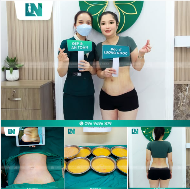 LẤY LẠI VÒNG EO THON GỌN NHỜ “HÚT MỠ SIẾT EO”