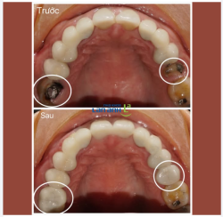 Răng bị bể tan nát rồi, có cố giữ lại được không ạ?