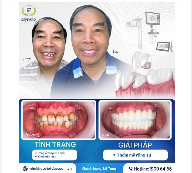 HÀNH TRÌNH TÁI TẠO NỤ CƯỜI CỦA ANH LÊ TÙNG TẠI NHA KHOA QUỐC TẾ VIỆT ĐỨC