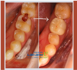 Khách hàng niềng răng ở nơi khác, niềng xong thì sâu răng ở cả 2 răng trong cùng với lỗ sâu thiệt bự...