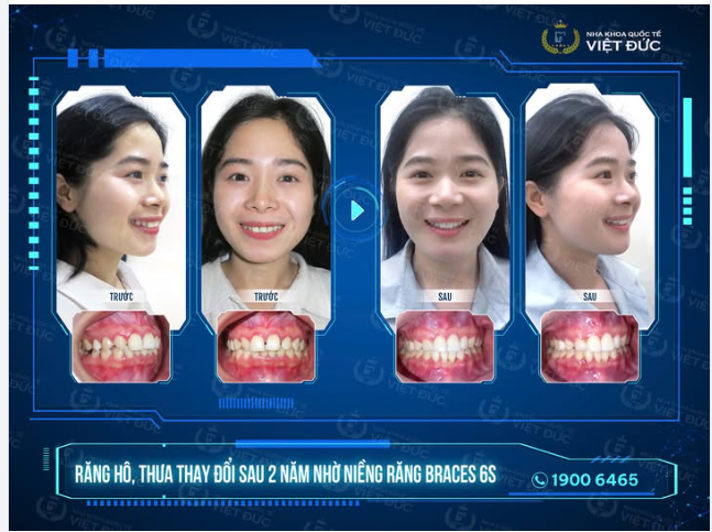 TỪ NỤ CƯỜI "E NGẠI" ĐẾN NỤ CƯỜI TRIỆU LIKE