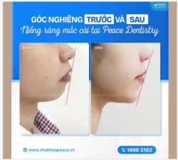 GÓC NGHIÊNG HOÀN HẢO SAU NIỀNG RĂNG TẠI PEACE DENTISTRY