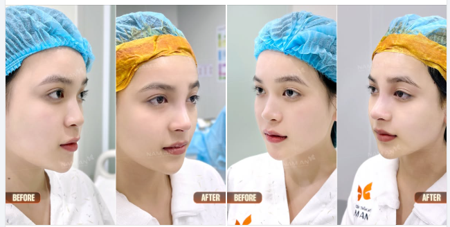 ĐẦU MŨI THẤP, SỐNG MŨI NGẮN THÌ NÊN LÀM GÌ???