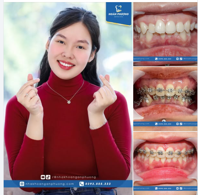 Nụ cười sáng bừng từ Bích Ngọc sau tháo niềng