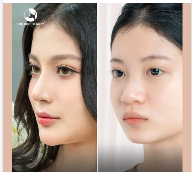 Nâng mũi ngay để kịp đón tết