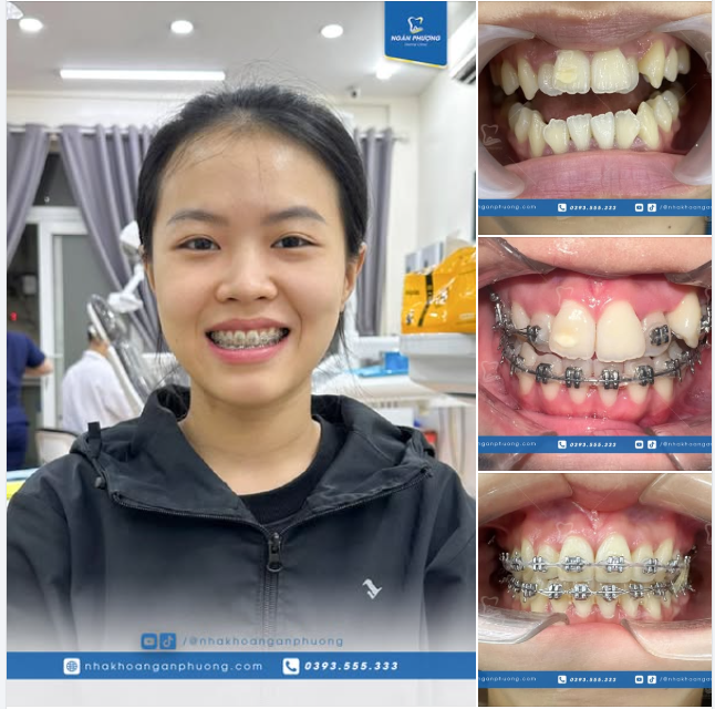 Quá trình niềng răng chìa và khấp khểnh sẽ như thế nào?