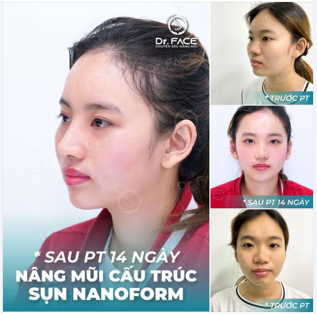 NÂNG MŨI vì câu nói: “ĐẸP NÊN CÓ QUYỀN”