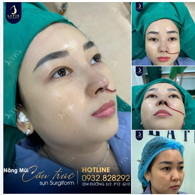 Mũi cấu trúc sụn tai vừa hoàn thành cho chị gái đến từ Đồng Tháp