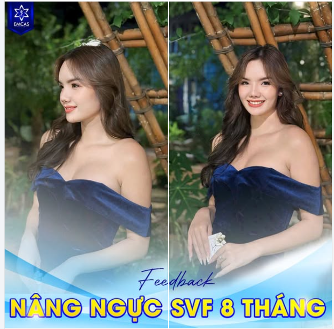 Nâng ngực SVF chỉ từ 41 Triệu